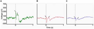 The Claustrum in Relation to Seizures and Electrical Stimulation